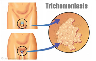 trichomoniasis